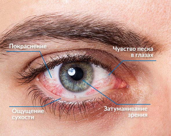 Глаз с осложнениями при ношение контактных линз