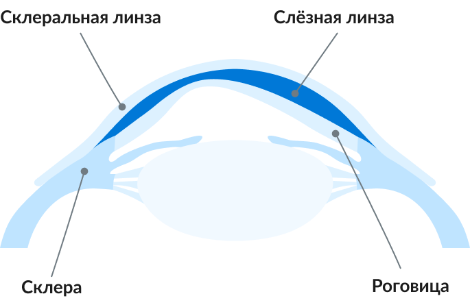 схема расположения линзы на склере глаза